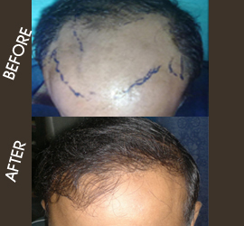 hair transplantation in patna