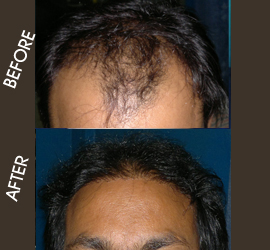 hair transplantation in patna