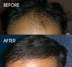 hair transplantation in patna