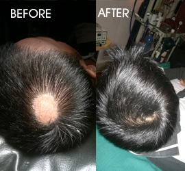 hair transplantation in patna