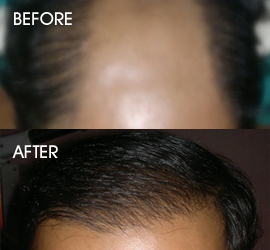 hair transplantation in patna