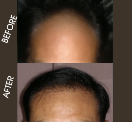hair transplantation in patna