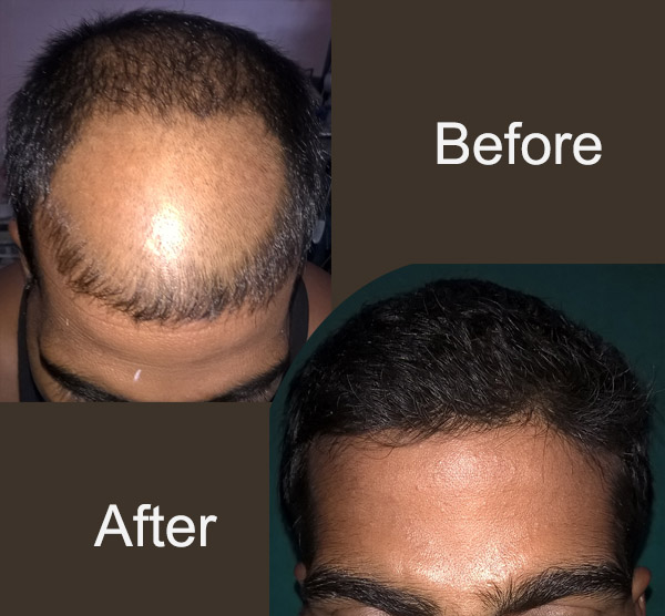 hair transplantation in patna hairtransplantationpatnacom  Ashutosh Hair  Transplant in PatnaHair Transplant In Patna Plastic Surgery in Patna  Cosmetic Surgery in Patna Treatment of Baldness in Patna Treatment of  Hair losss in